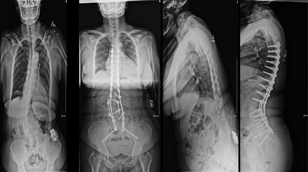 Case Study:multilevel lumbar laminectomy, L3 pedicle subtraction osteotomy, and T5-to-sacrum spinal fusion