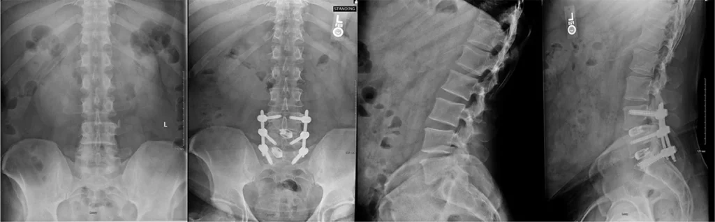 Case Study: The patient underwent a minimally invasive laminectomy and fusion from L4 to the sacrum.