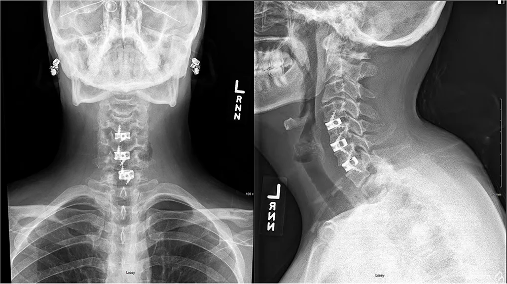 A 55-year-old male presented with debilitating neck and arm pain, progressive worsening of handwriting, and unsteady gait, which had led to multiple falls.