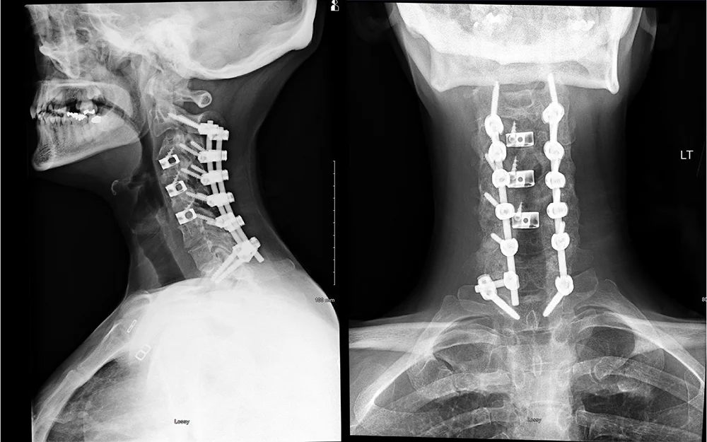 A 60-year-old female presented with debilitating neck and arm pain, progressive deterioration of handwriting, and unsteady gait, resulting in multiple falls. She was found to have a congenitally narrow spinal canal accompanied by a spinal deformity.